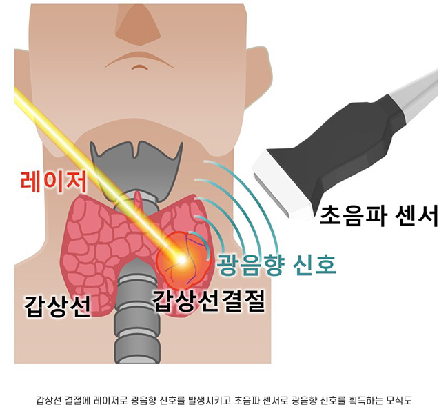 갑상선 결절에 레이저로 광음향 신호를 발생시키고 초음파 센서로 광음향 신호를 획득하는 모식도